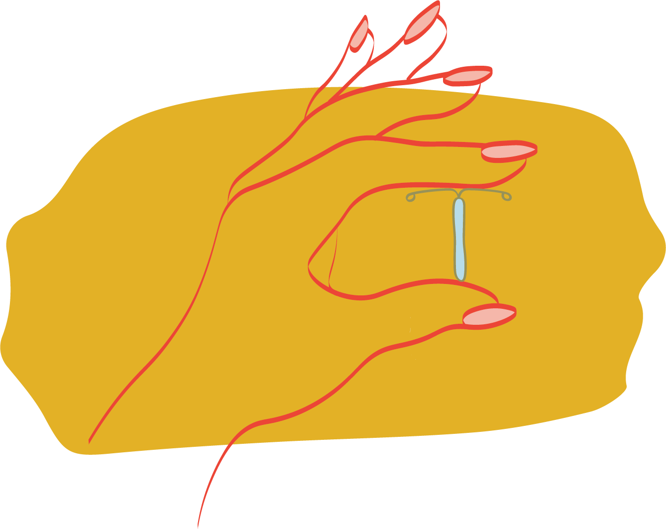 Progestin IUD birth control device