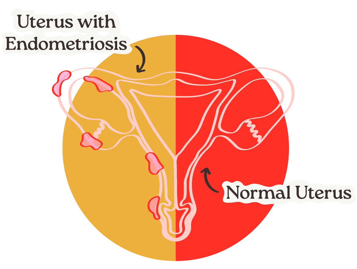 Comparison of a normal uterus and a uterus with endometriosis