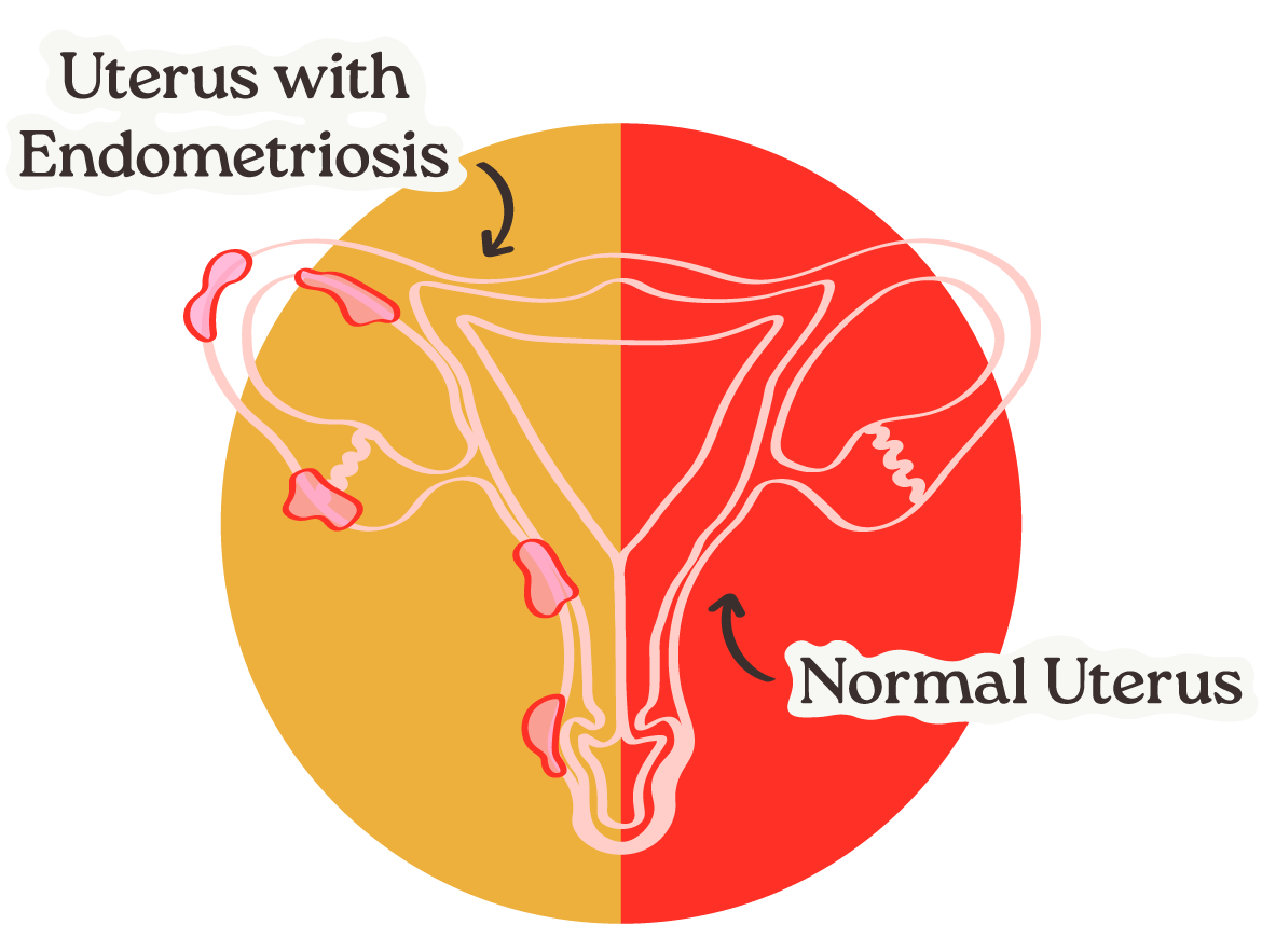 What is Endometriosis ?